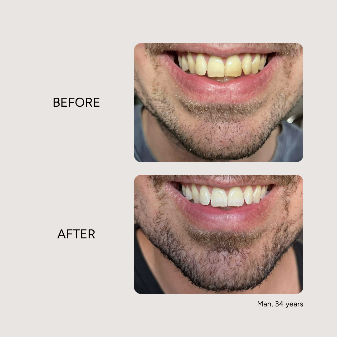 Essential Whitening & Remineralizing Kit