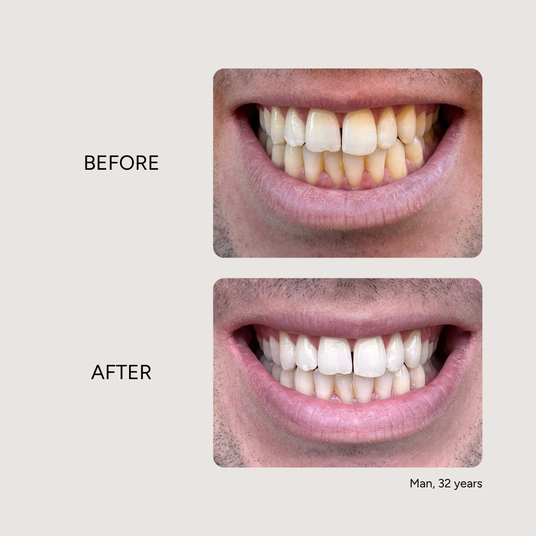 Essential Whitening & Remineralizing Kit