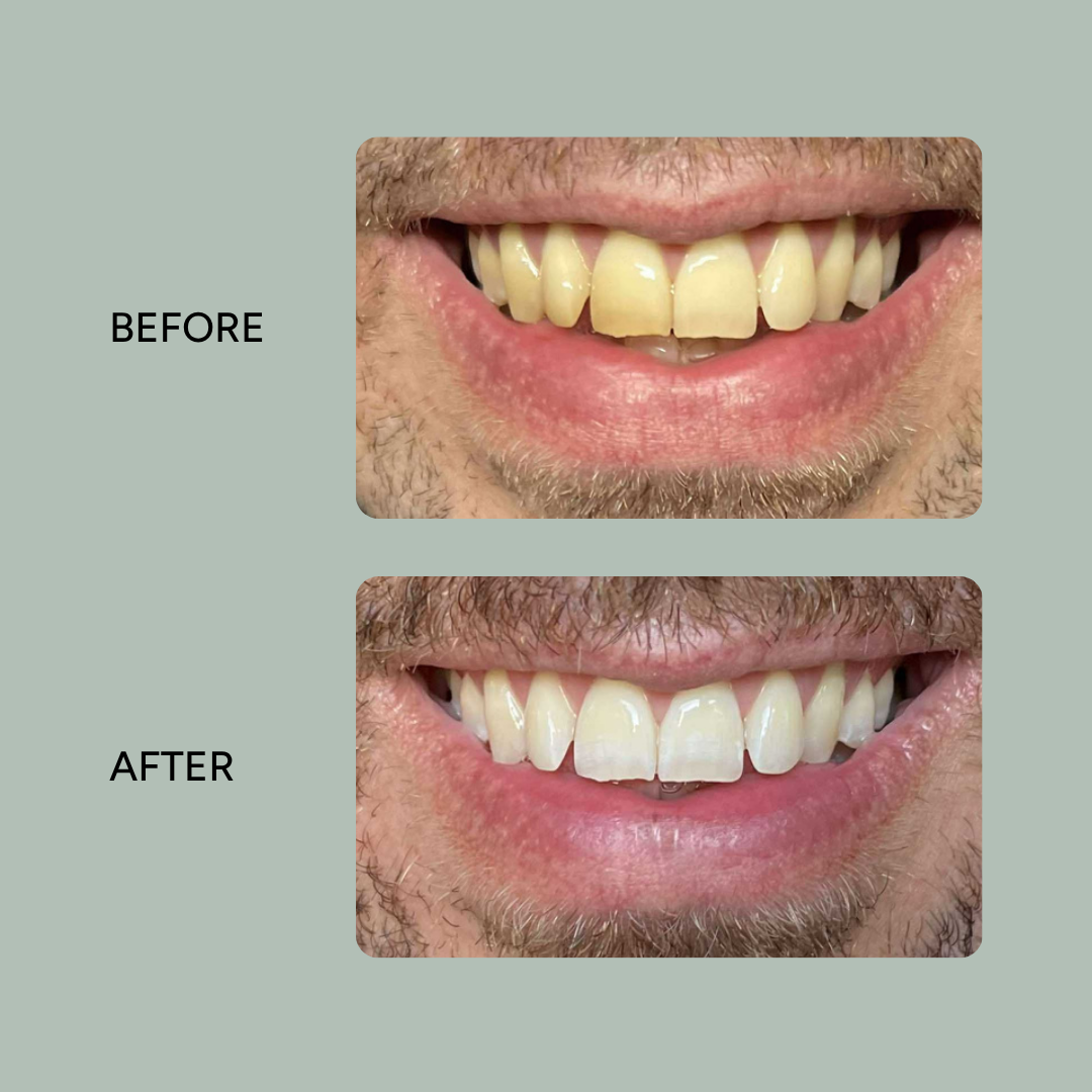 Meta_Ad_Before_After_Instagram_Post_1.png