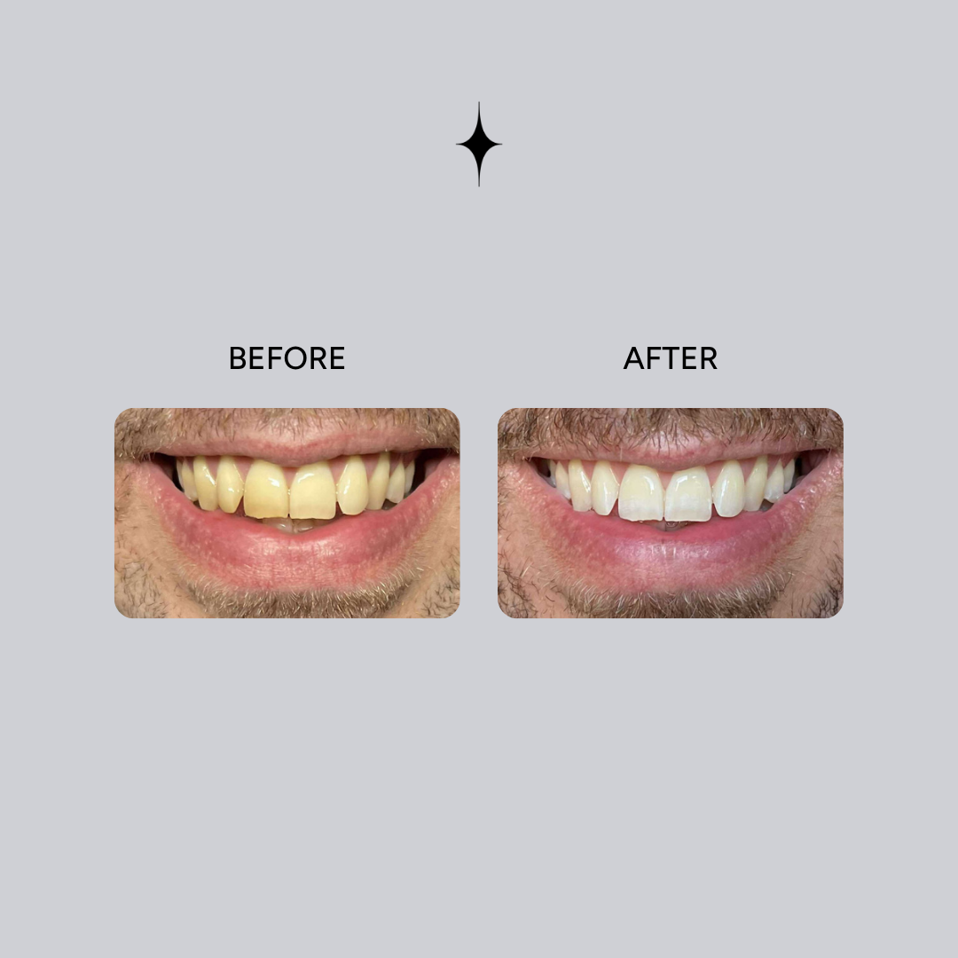 Essential Whitening & Remineralizing Kit