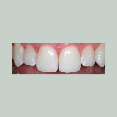 Teeth after using Essential Whitening Toothpaste