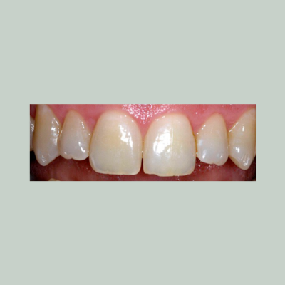 Teeth before using Essential Whitening Toothpaste