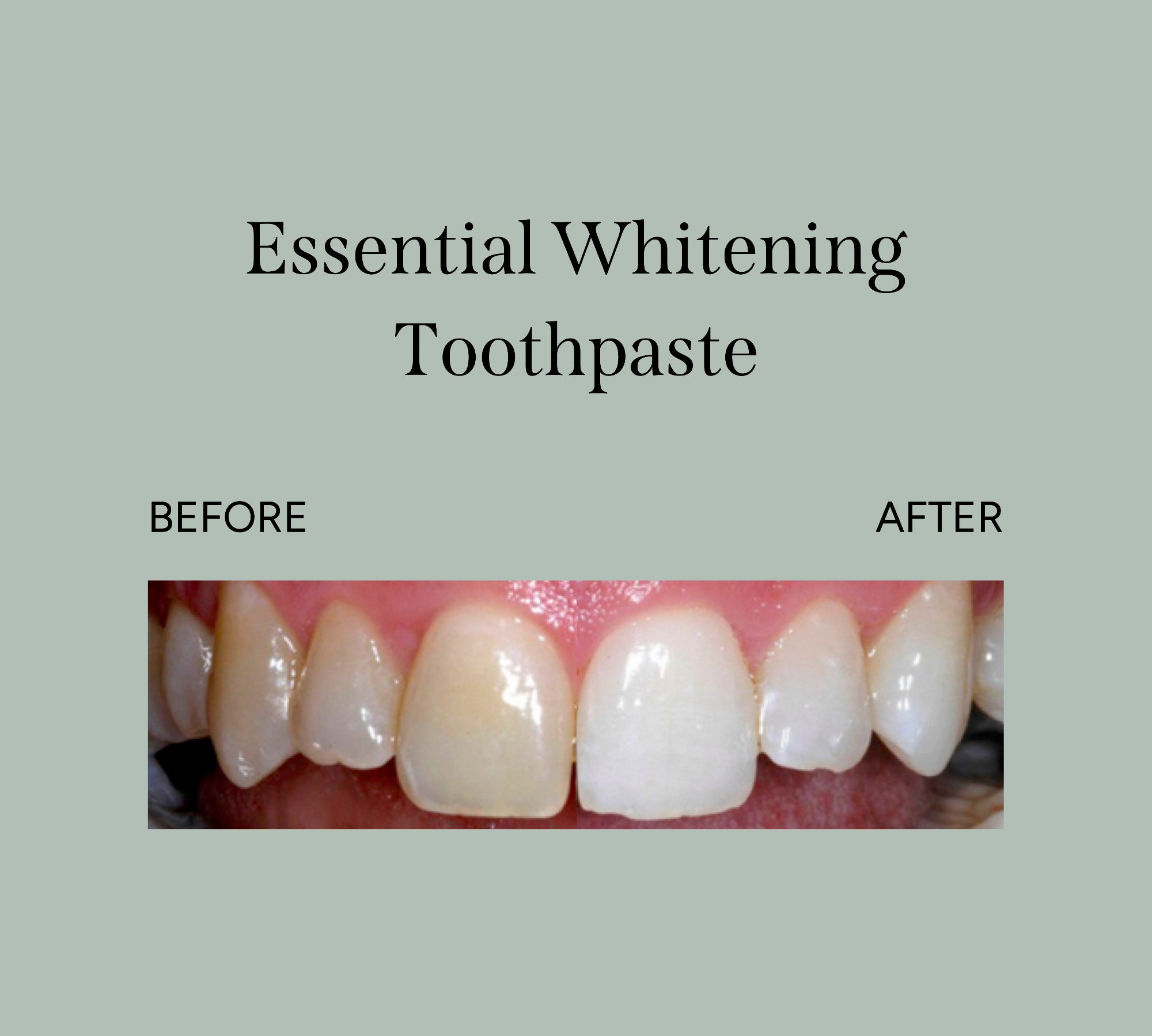 Before and after picture of whitened teeth. 